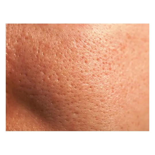 Pores dilatés : quelles sont les causes et quelles sont les solutions ?